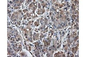 Immunohistochemical staining of paraffin-embedded Carcinoma of liver tissue using anti-TPMT mouse monoclonal antibody. (TPMT antibody)