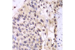 Immunohistochemistry of paraffin-embedded human lung cancer using PSMA6 antibody at dilution of 1:100 (400x lens). (PSMA6 antibody)