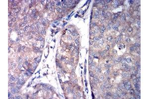 Immunohistochemical analysis of paraffin-embedded bladder cancer tissues using ASGR2 mouse mAb with DAB staining. (Asialoglycoprotein Receptor 2 antibody  (AA 80-311))