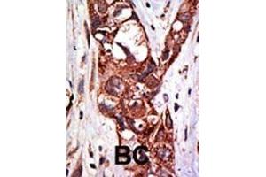Formalin-fixed and paraffin-embedded human cancer tissue reacted with the primary antibody, which was peroxidase-conjugated to the secondary antibody, followed by DAB staining. (SAE1 antibody  (C-Term))
