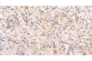Immunohistochemistry of paraffin-embedded Human renal cancer using MMP11 Polyclonal Antibody at dilution of 1:40 (MMP11 antibody)