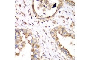 Immunohistochemistry of paraffin-embedded human liver cancer using HADHA antibody (ABIN6292979) at dilution of 1:100 (40x lens). (HADHA antibody)