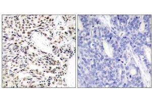 Immunohistochemical analysis of paraffin-embedded human breast carcinoma tissue using NF-κB p65 (Ab-529) antibody (E021210). (NF-kB p65 antibody)