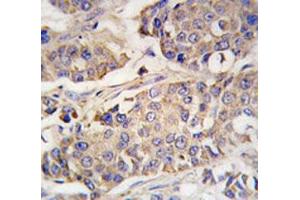 IHC analysis of FFPE human breast carcinoma tissue stained with ACO2 antibody (ACO2 antibody  (AA 294-325))