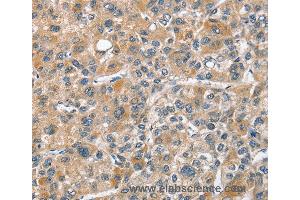 Immunohistochemistry of Human thyroid cancer using CHMP4B Polyclonal Antibody at dilution of 1:40 (CHMP4B antibody)