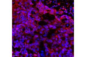 Immunofluorescence of paraffin embedded human esophagus cancer using Neil1 (ABIN7073820) at dilution of 1: 300 (400x lens) (NEIL1 antibody)