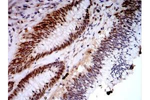 Immunohistochemical analysis of paraffin-embedded colon cancer tissues using KDM1A mouse mAb with DAB staining. (LSD1 antibody  (AA 55-263))