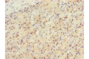 Immunohistochemistry of paraffin-embedded human liver cancer using ABIN7169695 at dilution of 1:100 (SIPA1L2 antibody  (AA 522-778))