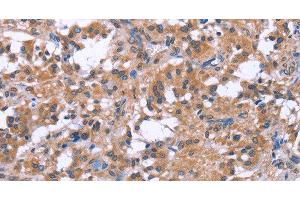 Immunohistochemistry of paraffin-embedded Human thyroid cancer tissue using GPR172B Polyclonal Antibody at dilution 1:40 (GPR172B antibody)