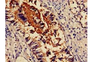 Immunohistochemistry of paraffin-embedded human lung tissue using ABIN7143831 at dilution of 1:100 (alpha Actinin 4 antibody  (AA 6-277))
