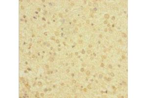 Immunohistochemistry of paraffin-embedded human glioma using ABIN7143220 at dilution of 1:100 (Diazepam Binding Inhibitor antibody  (AA 2-105))