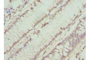 Immunohistochemistry of paraffin-embedded human colon cancer using ABIN7160753 at dilution of 1:100
