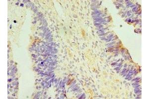 Immunohistochemistry of paraffin-embedded human ovarian cancer using ABIN7150151 at dilution of 1:100 (APOBEC3C antibody  (AA 1-190))