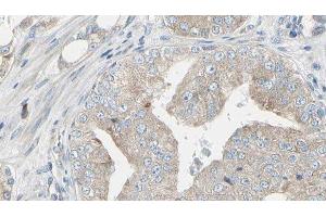 ABIN6279799 at 1/100 staining Human prostate tissue by IHC-P. (RIOK1 antibody  (C-Term))