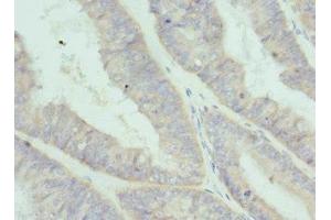 Immunohistochemistry of paraffin-embedded human endometrial cancer using ABIN7156846 at dilution of 1:100 (IL-2 antibody  (AA 25-176))