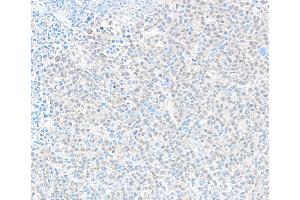 Immunohistochemistry (IHC) image for anti-Denticleless E3 Ubiquitin Protein Ligase Homolog (DTL) (C-Term) antibody (ABIN7454696)