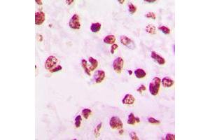 Immunohistochemical analysis of SNAI1 staining in human lung cancer formalin fixed paraffin embedded tissue section. (SNAIL antibody  (C-Term))