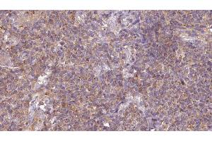 ABIN6273201 at 1/100 staining Human lymph cancer tissue by IHC-P. (ARL6 antibody  (Internal Region))