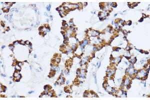 Immunohistochemistry of paraffin-embedded Human thyroid cancer using MAOA Polyclonal Antibody at dilution of 1:100 (40x lens). (Monoamine Oxidase A antibody)