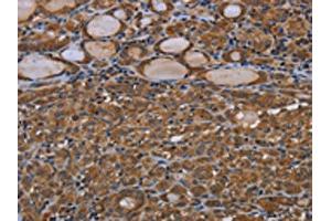 The image on the left is immunohistochemistry of paraffin-embedded Human thyroid cancer tissue using ABIN7190808(GJB4 Antibody) at dilution 1/40, on the right is treated with synthetic peptide. (GJB4 antibody)