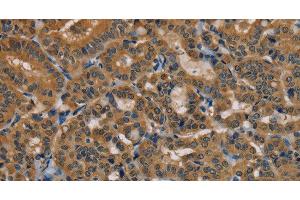 Immunohistochemistry of paraffin-embedded Human thyroid cancer using TAB3 Polyclonal Antibody at dilution of 1:35 (TAB3 antibody)