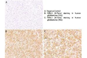 Immunohistochemistry with anti-MEK2 (N-Term) antibody showing positive staining in human glioblastoma tissue at 20x and 40x (B & C). (MEK2 antibody  (C-Term))