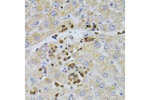 Immunohistochemistry of paraffin-embedded human liver injury using BEST1 antibody (ABIN6003520) at dilution of 1/100 (40x lens). (Bestrophin 1 antibody)