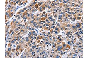 The image on the left is immunohistochemistry of paraffin-embedded Human liver cancer tissue using ABIN7129371(ENPP5 Antibody) at dilution 1/40, on the right is treated with fusion protein. (ENPP5 antibody)