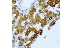 Immunohistochemical analysis of KIF3A staining in human liver cancer formalin fixed paraffin embedded tissue section. (KIF3A antibody)