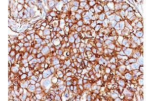 Formalin-fixed, paraffin-embedded human Breast Carcinoma stained with CD44 Mouse Monoclonal Antibody (HCAM/918). (CD44 antibody)
