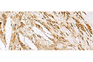 Immunohistochemistry of paraffin-embedded Human thyroid cancer tissue using DNPEP Polyclonal Antibody at dilution of 1:60(x200) (Aspartyl Aminopeptidase antibody)