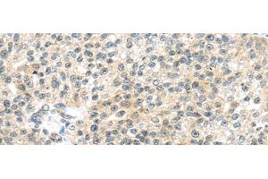 Immunohistochemistry of paraffin-embedded Human breast cancer tissue using TTBK2 Polyclonal Antibody at dilution 1:45 (TTBK2 antibody)
