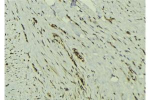 ABIN6273132 at 1/100 staining Human breast cancer tissue by IHC-P. (MAD2L2 antibody  (Internal Region))