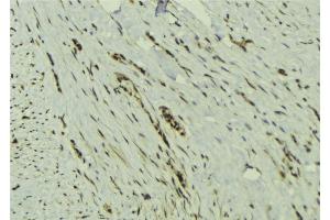 ABIN6273132 at 1/100 staining Human breast cancer tissue by IHC-P.