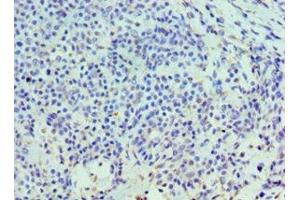 Immunohistochemistry of paraffin-embedded human breast cancer using ABIN7155973 at dilution of 1:100 (HYAL3 antibody  (AA 198-417))