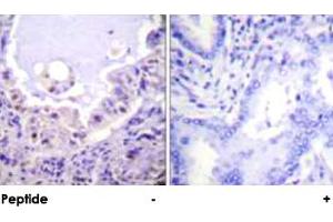 Immunohistochemical analysis of paraffin-embedded human lung carcinoma tissue using RAF1 polyclonal antibody .