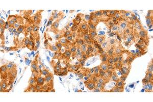 Immunohistochemistry of paraffin-embedded Human lung cancer tissue using GLUT-4 Polyclonal Antibody at dilution 1:70 (GLUT4 antibody)