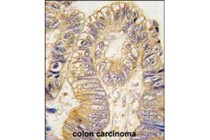 Formalin-fixed and paraffin-embedded human colon carcinoma tissue reacted with CLIC5 antibody , which was peroxidase-conjugated to the secondary antibody, followed by DAB staining. (CLIC5 antibody)