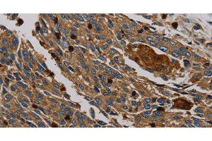 Immunohistochemistry of paraffin-embedded Human lung cancer tissue using PER2 Polyclonal Antibody at dilution 1:50 (PER2 antibody)