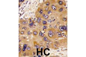 Formalin-fixed and paraffin-embedded human hepatocellular carcinoma tissue reacted with HNMT polyclonal antibody , which was peroxidase-conjugated to the secondary antibody, followed by DAB staining. (HNMT antibody  (N-Term))