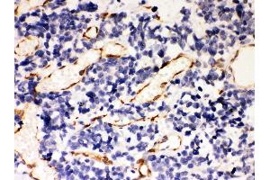 Anti- Hsp47 Picoband antibody, IHC(P) IHC(P): Human Lung Cancer Tissue (SERPINH1 antibody  (AA 247-418))