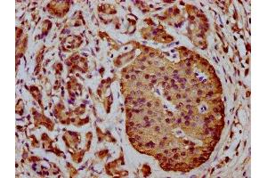 IHC image of ABIN7166183 diluted at 1:400 and staining in paraffin-embedded human pancreatic cancer performed on a Leica BondTM system. (C1orf38 antibody  (AA 62-177))