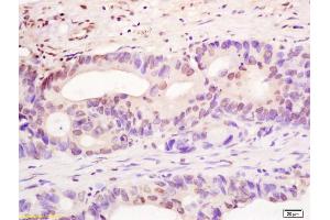 Formalin-fixed and paraffin embedded human colon carcinoma labeled with Rabbit Anti YBX-1/YB1 Polyclonal Antibody, Unconjugated (ABIN759851) at 1:200 followed by conjugation to the secondary antibody and DAB staining (YBX1 antibody)