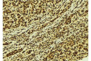 ABIN6274181 at 1/100 staining Human breast cancer tissue by IHC-P. (UBTF antibody  (Internal Region))