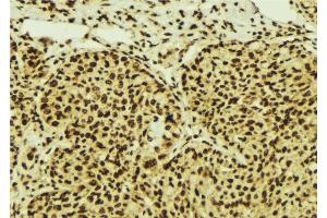 ABIN6274549 at 1/100 staining Human breast cancer tissue by IHC-P. (ZNF148 antibody  (N-Term))