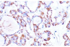 Immunohistochemistry of paraffin-embedded Human thyroid cancer using ISG15 Polyclonal Antibody at dilution of 1:100 (40x lens). (ISG15 antibody)