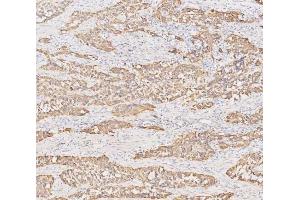 IHC analysis of Cytokeratin 19 using anti-Cytokeratin 19 antibody (ABIN3043288). (Cytokeratin 19 antibody  (C-Term))