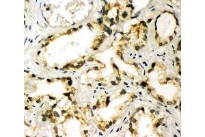 IHC-P: TBK1 antibody testing of human prostate cancer tissue (TBK1 antibody  (C-Term))