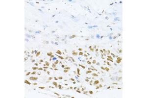 Immunohistochemistry of paraffin-embedded human lung cancer using DNMT1 antibody (ABIN5973205) at dilution of 1/100 (40x lens).