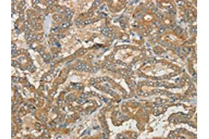 The image on the left is immunohistochemistry of paraffin-embedded Human thyroid cancer tissue using ABIN7190392(CWC27 Antibody) at dilution 1/40, on the right is treated with synthetic peptide. (Cwc27 antibody)